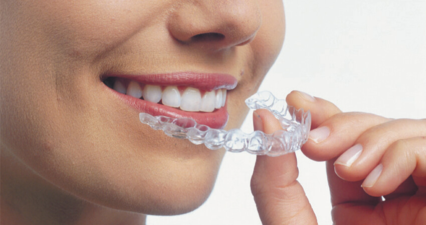 Clear-Aligners