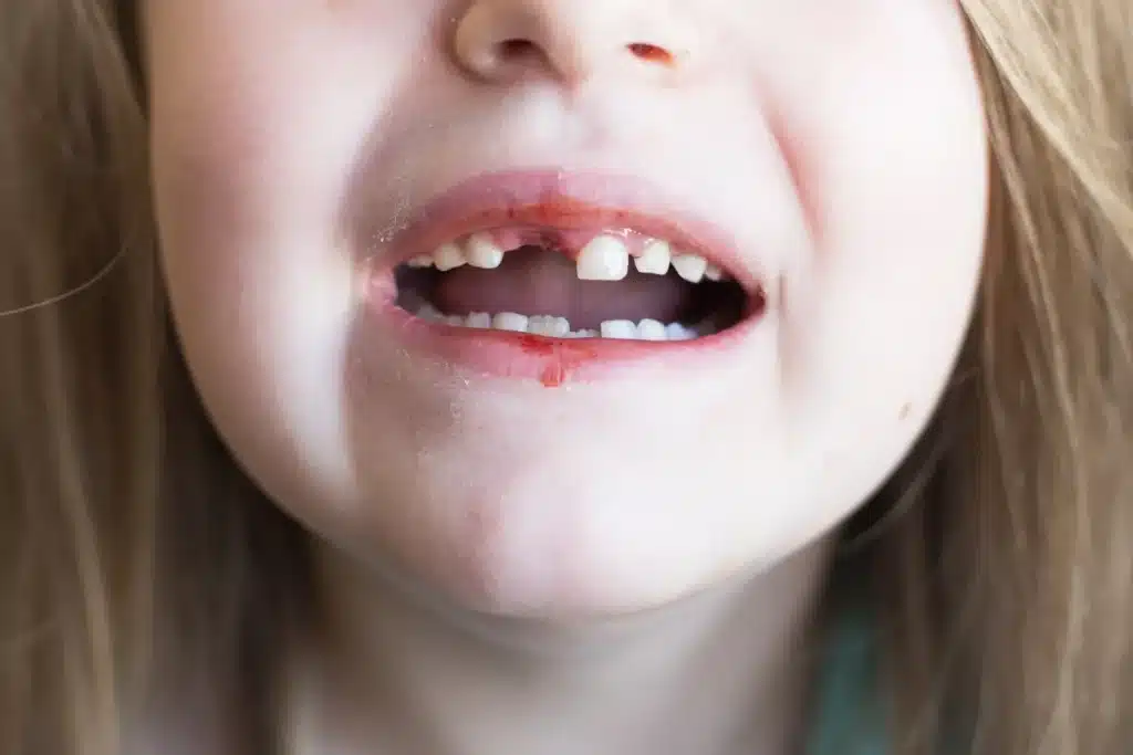 broken tooth of a child.