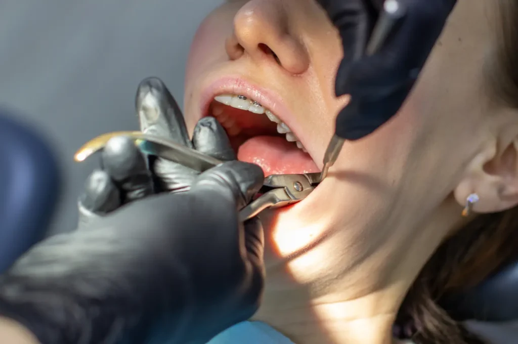 tooth extraction
