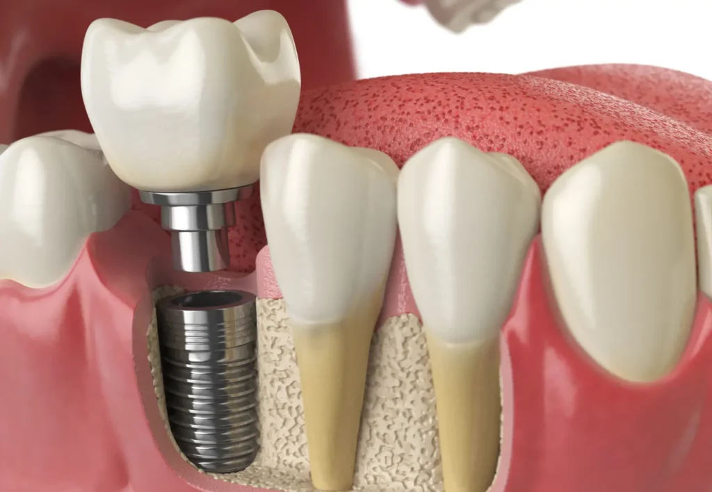 dental implant