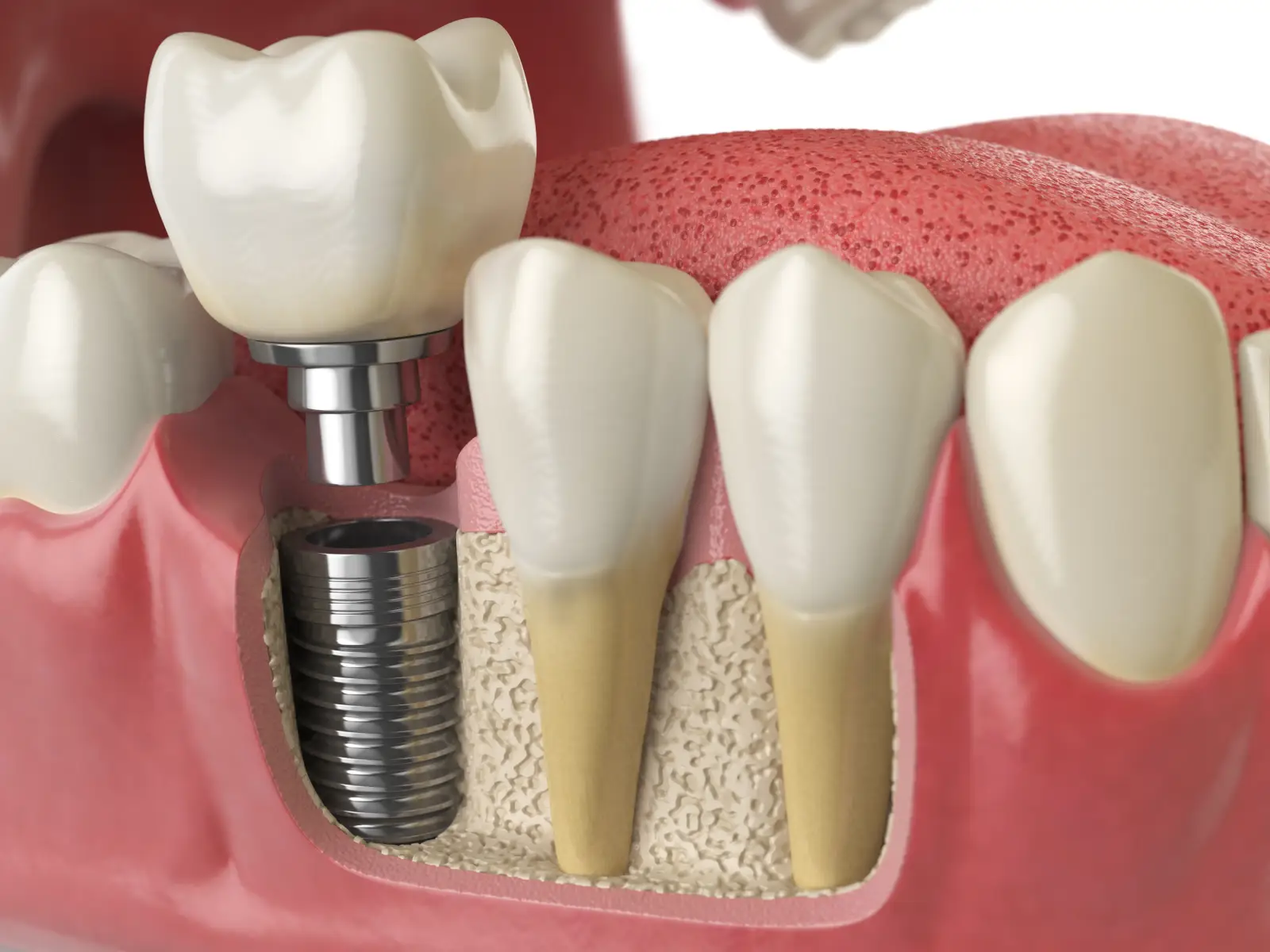 process of all on four dental implants