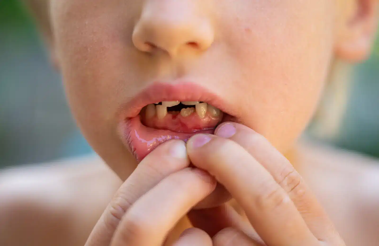 boy with dental avulsion problem.