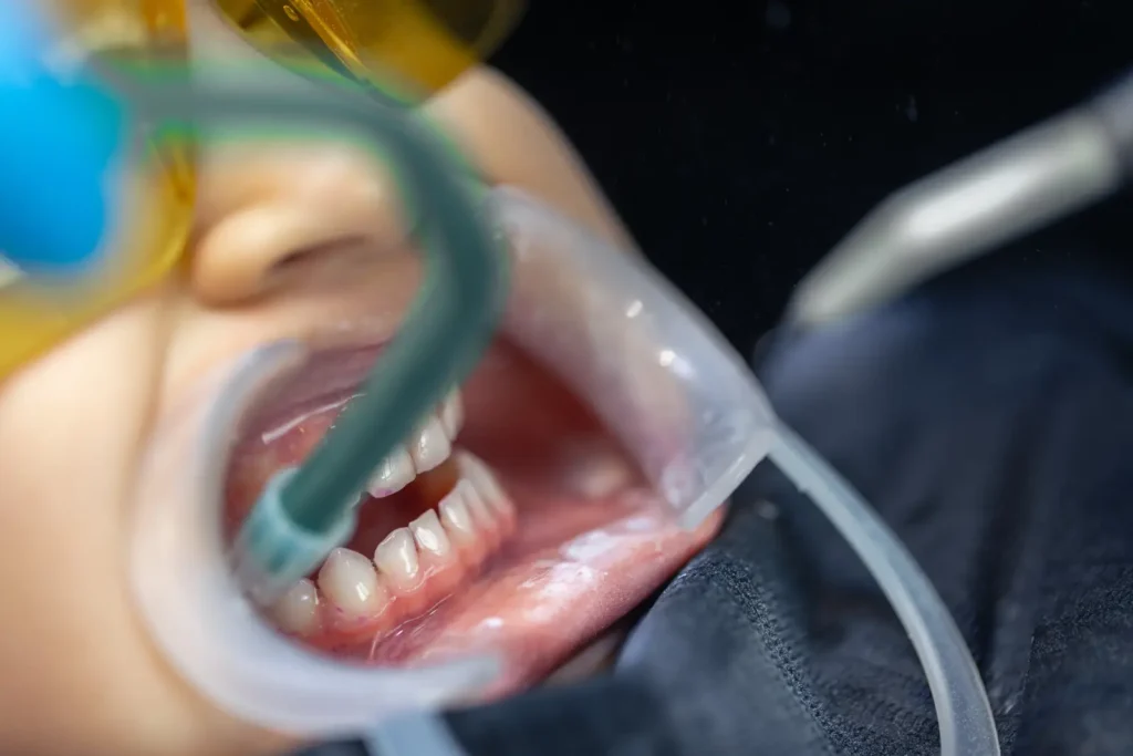 kids tooth extraction