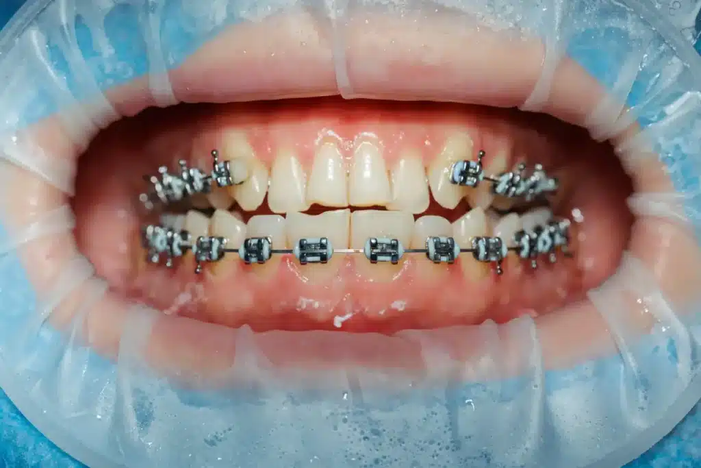 dental braces in brisbane