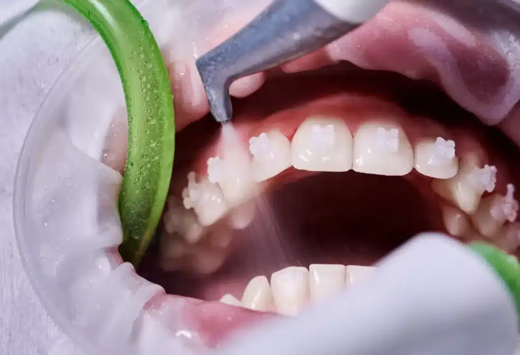 close up picture of dental cleaning