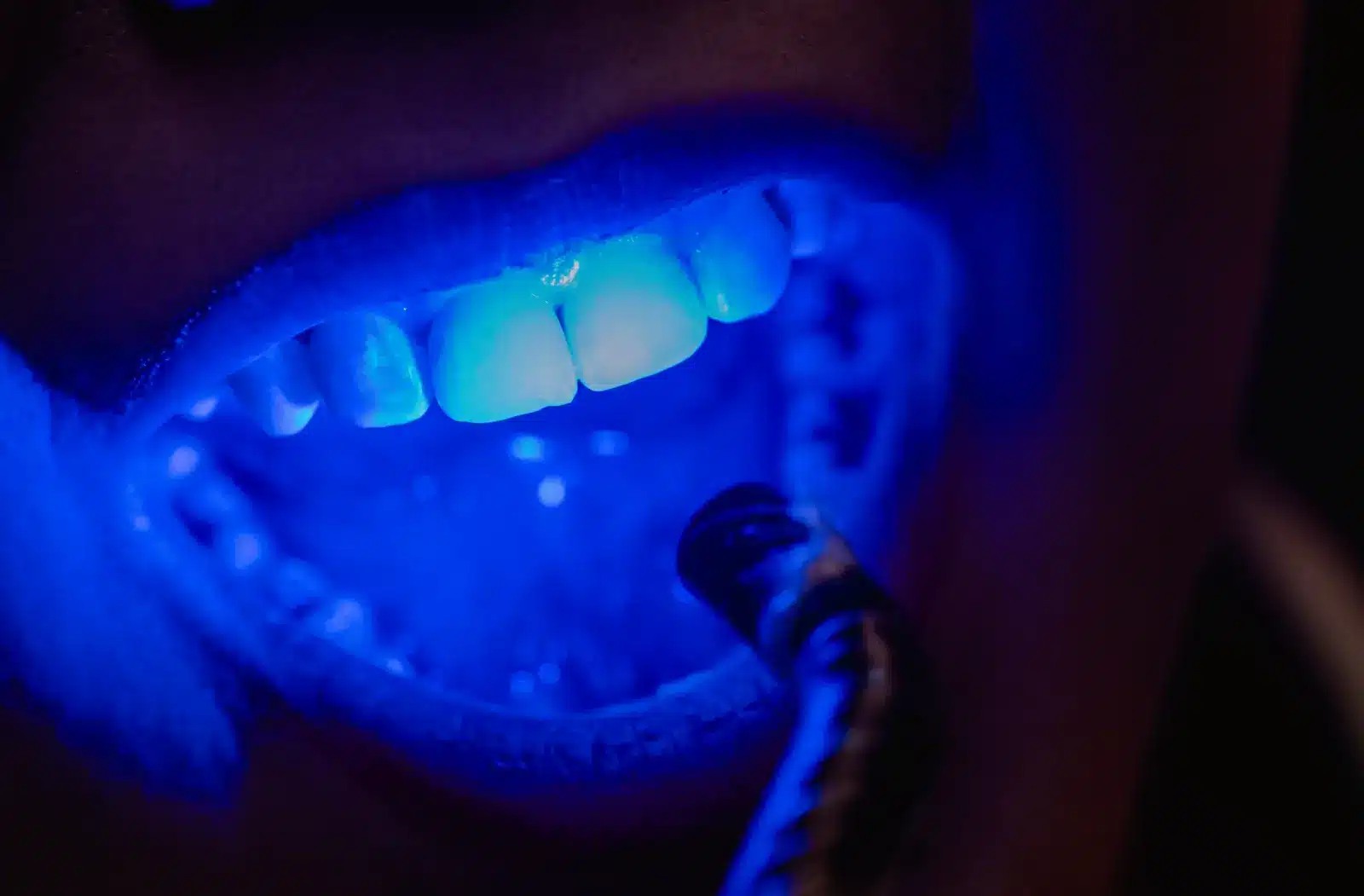 teeth whitening
