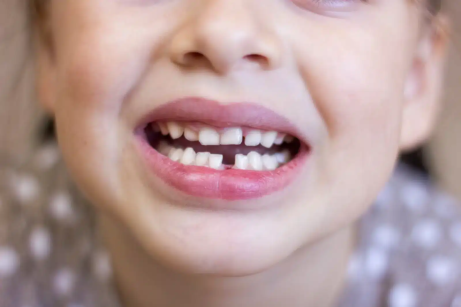 child mouth closeup broken tooth