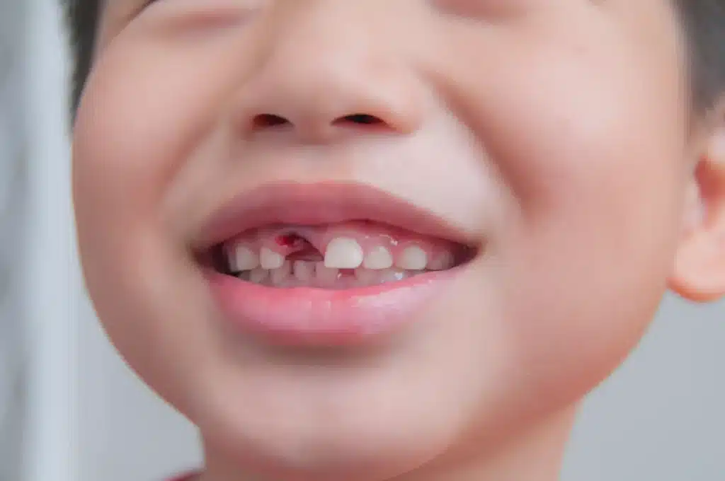 close up of knocked out tooth