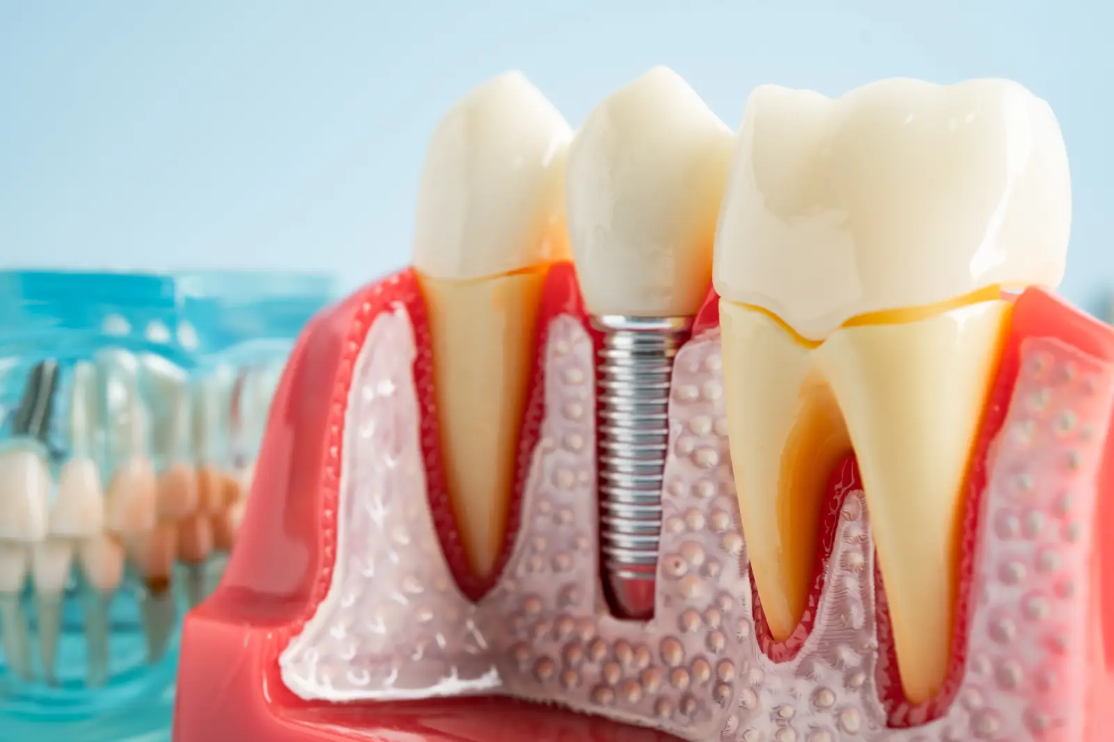 dental implant