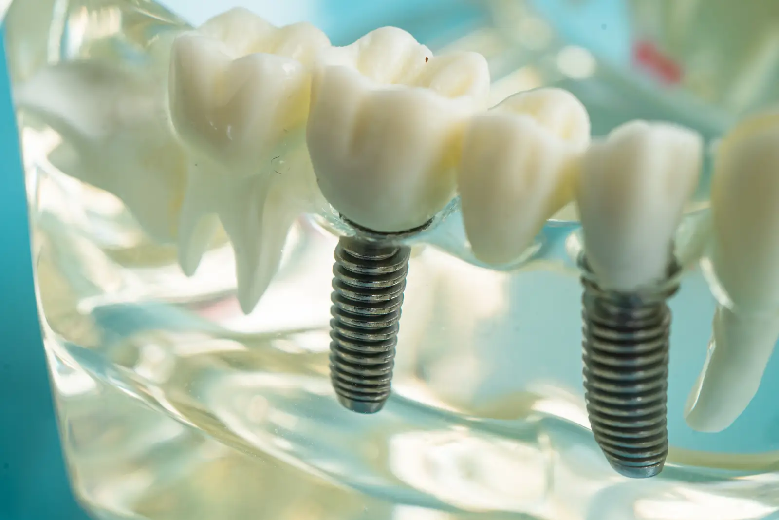 dental implants