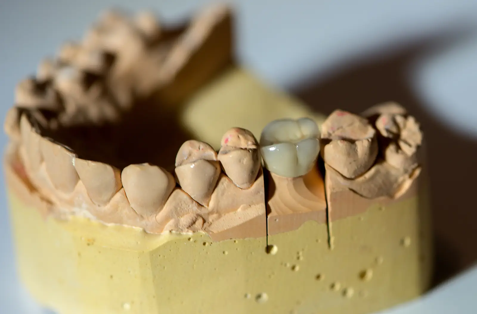 dental prosthesis