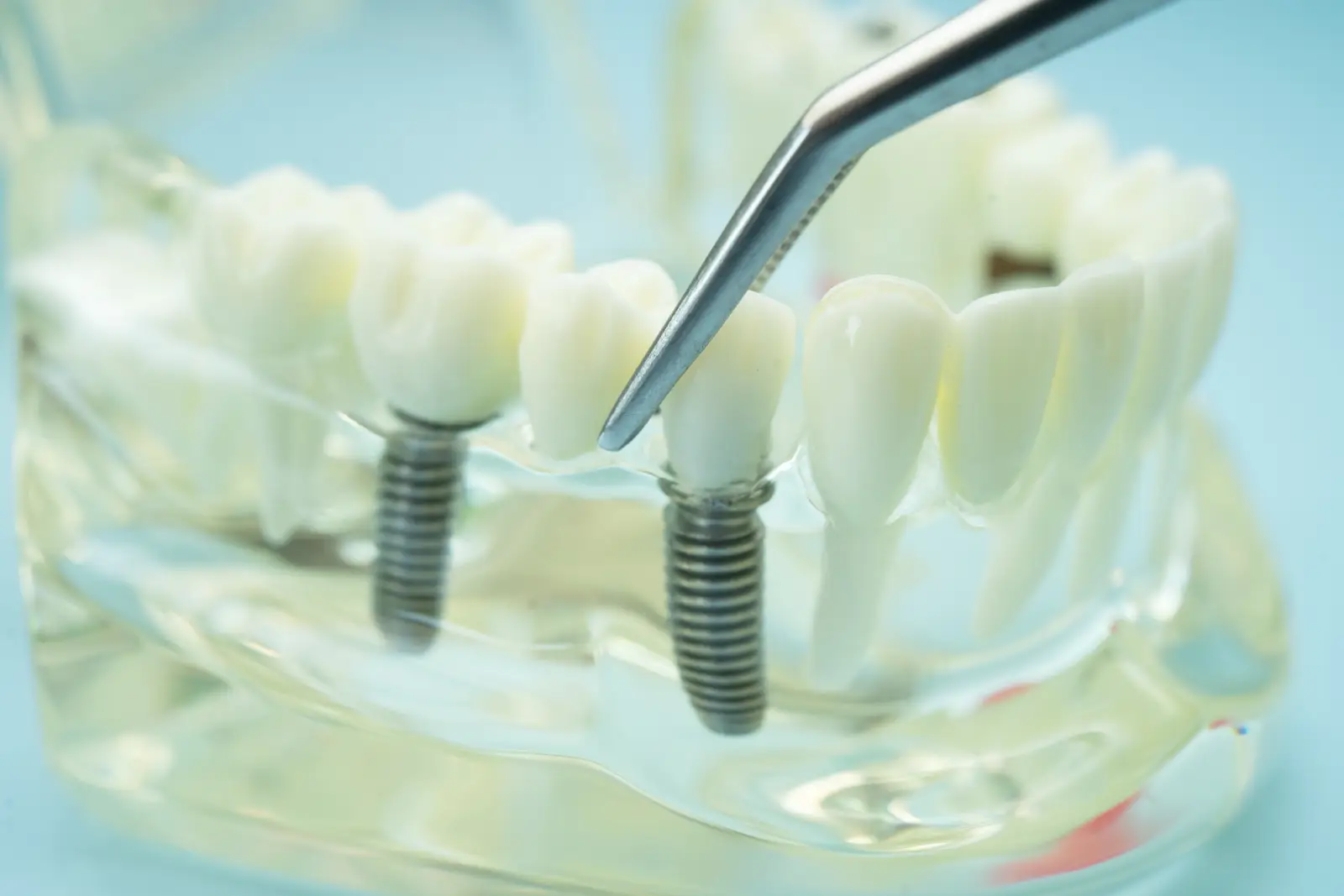 dental teeth model to be used in dental implant.
