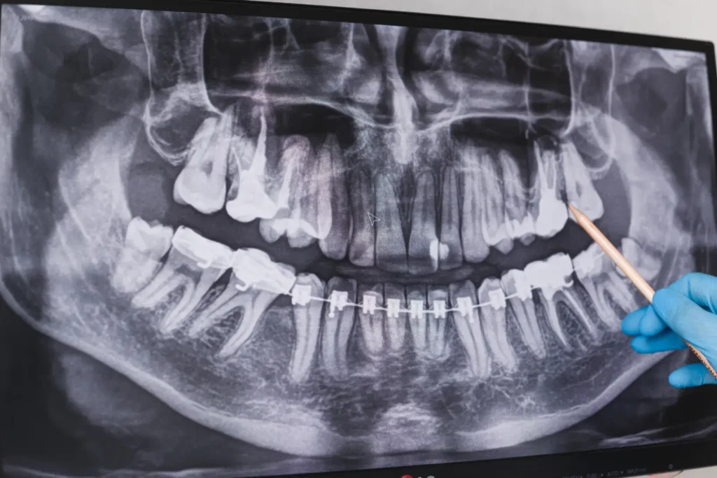 wisdom tooth extraction