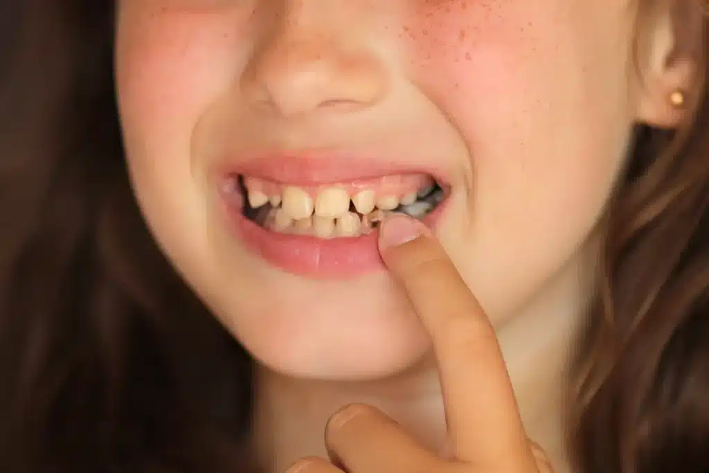 tooth discolouration occuring in kid's teeth