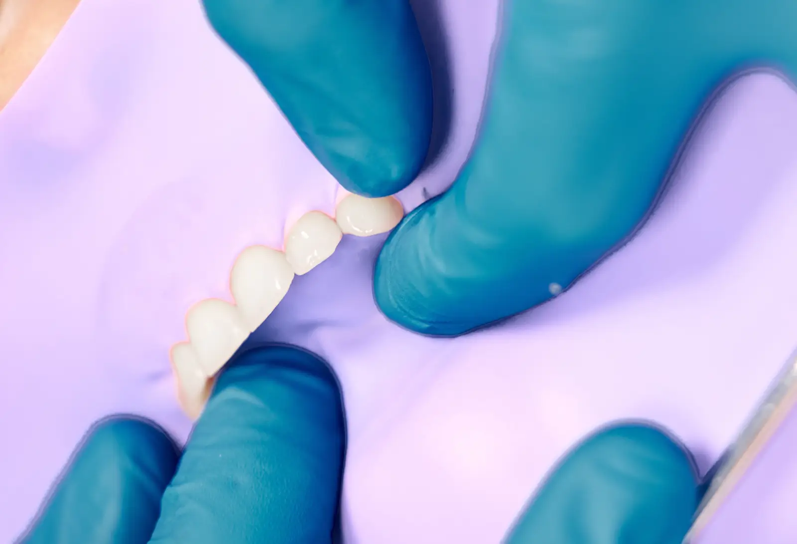 dental bridge at dental nook brisbane