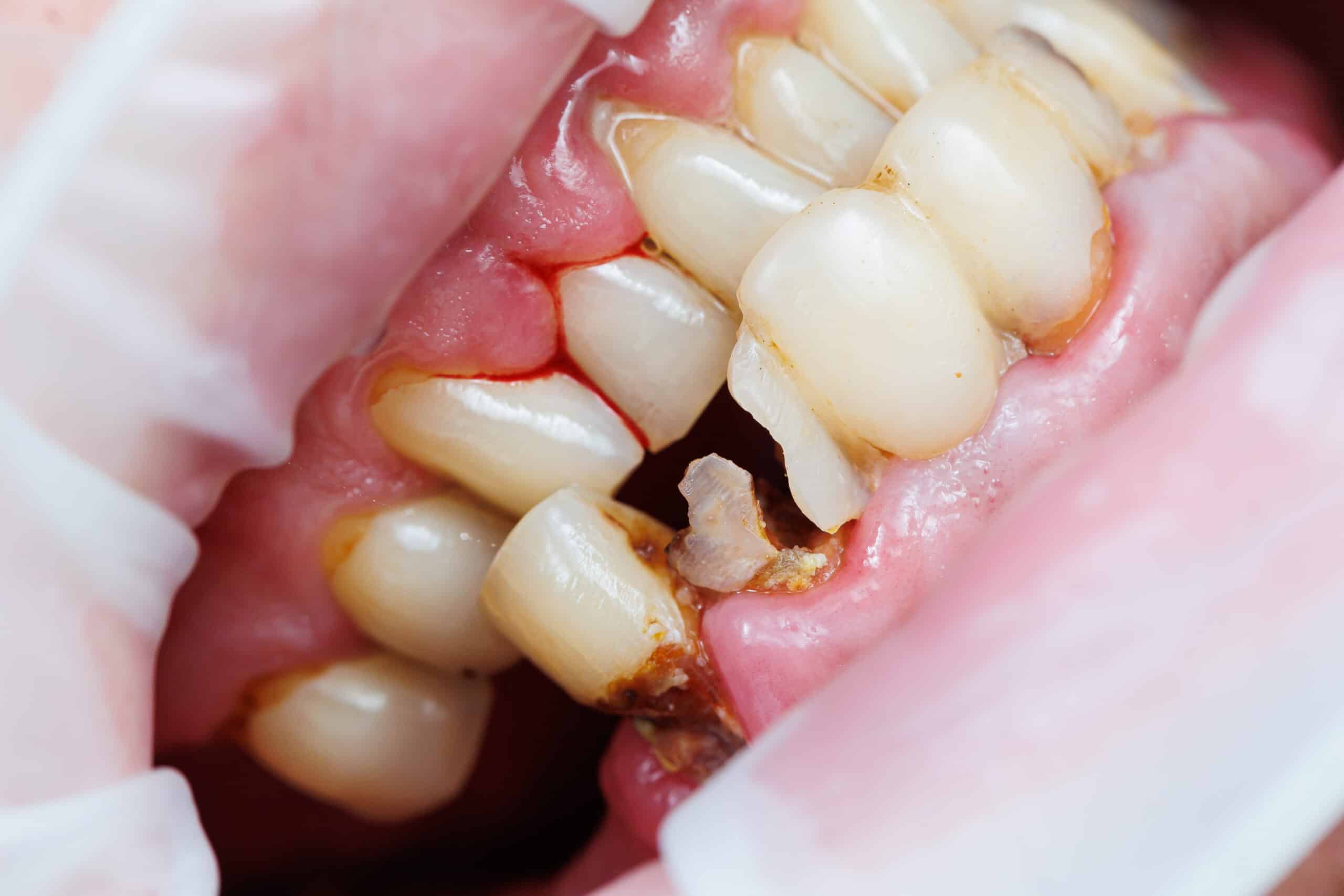 broken tooth image from a patient's mouth.