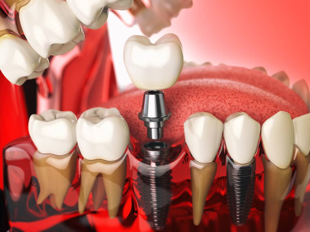 tooth implant