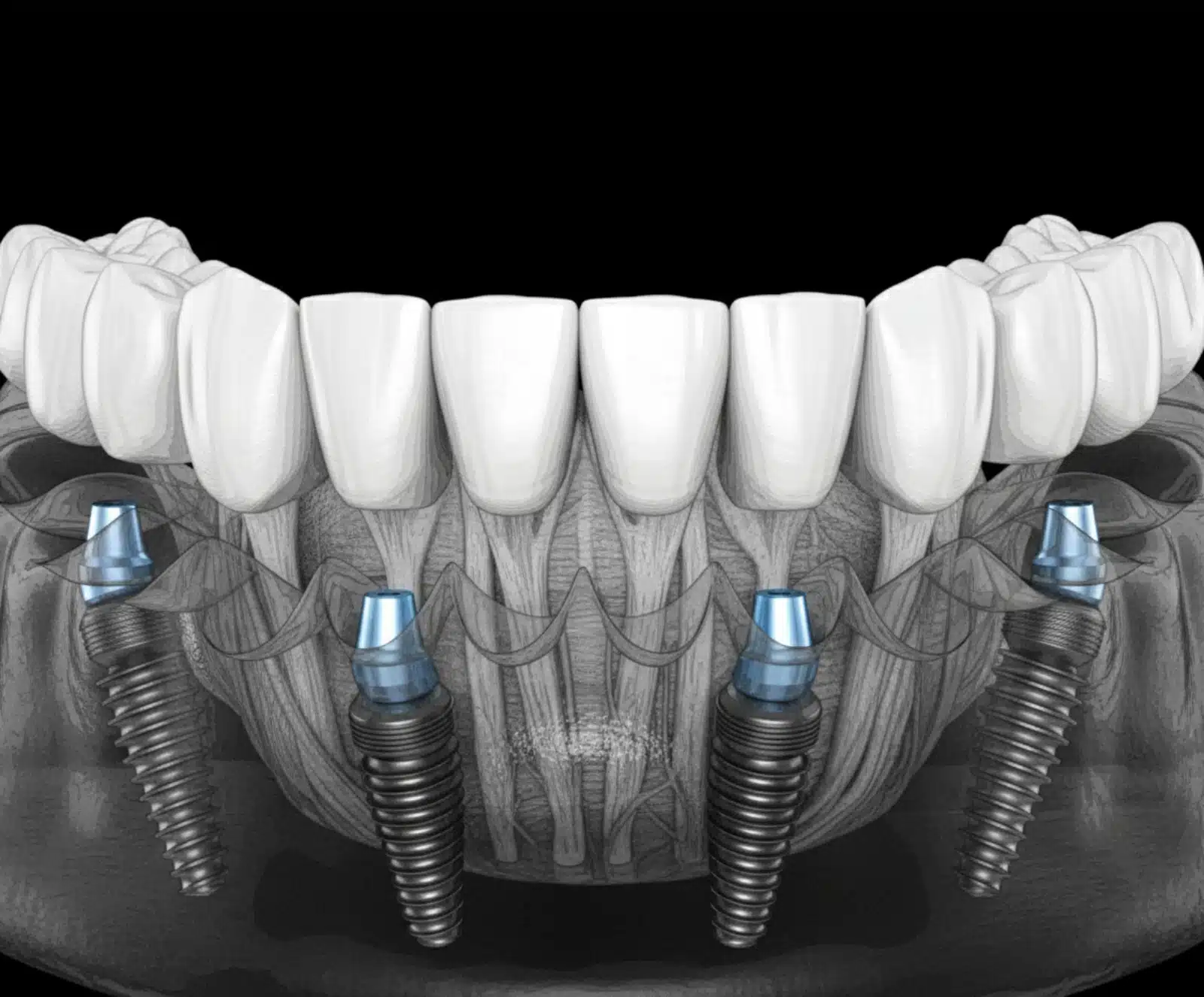 all in 4 implants