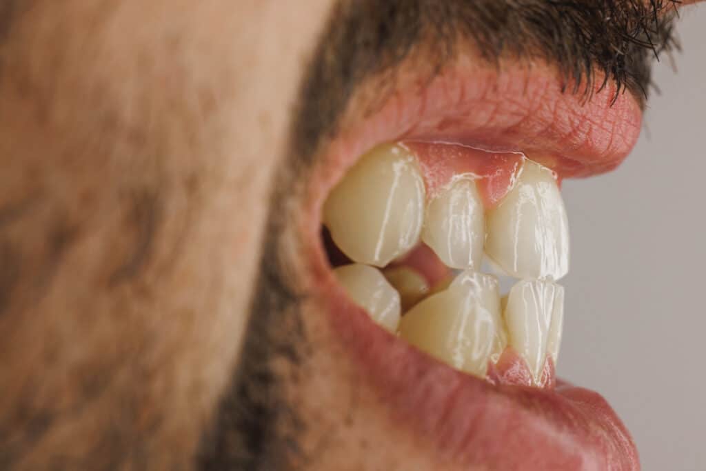 bruxism
