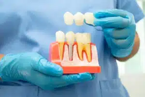 dental implants