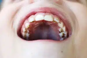 tooth decay in kids