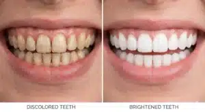 teeth whitening