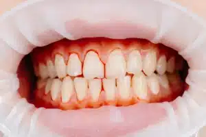 bleeding gums