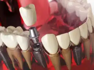 tooth implant model
