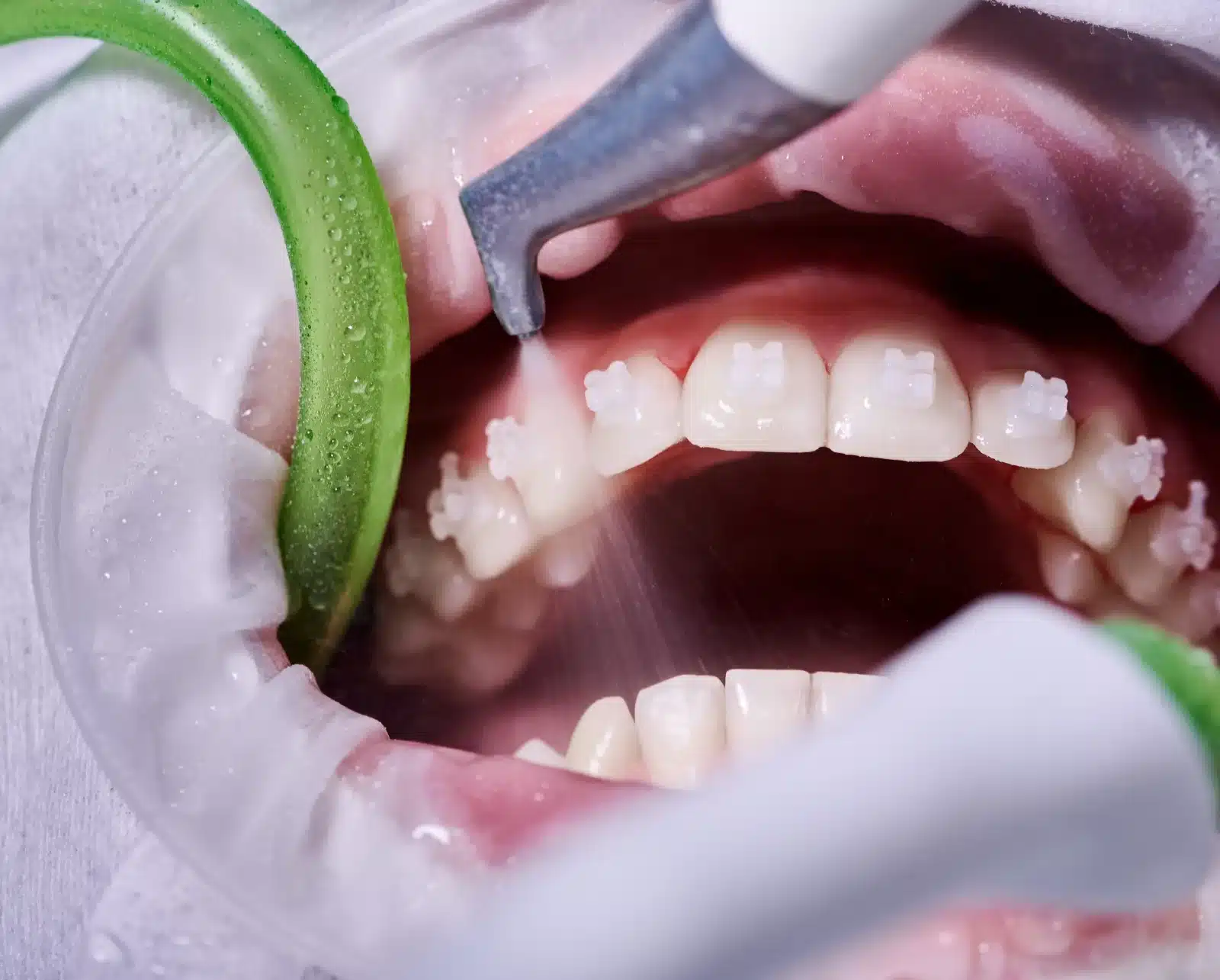 Close up of cleaning the tooth professionally