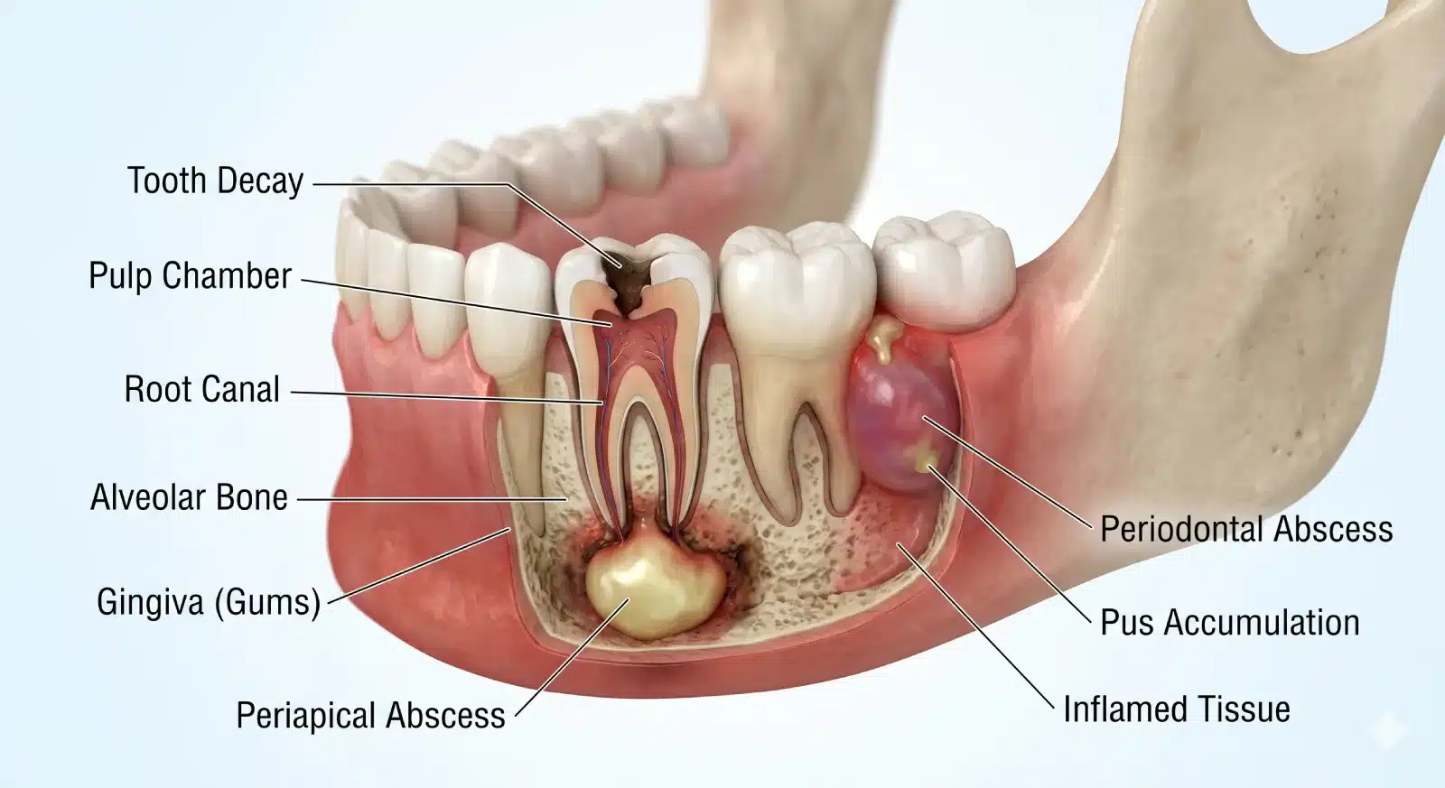 Dental Abscess - Dental Nook