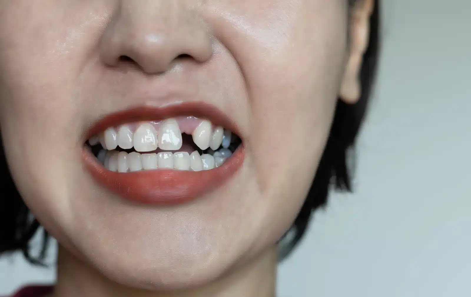 Close-up of a missing tooth and surrounding teeth illustrating the need for a dental bridge.