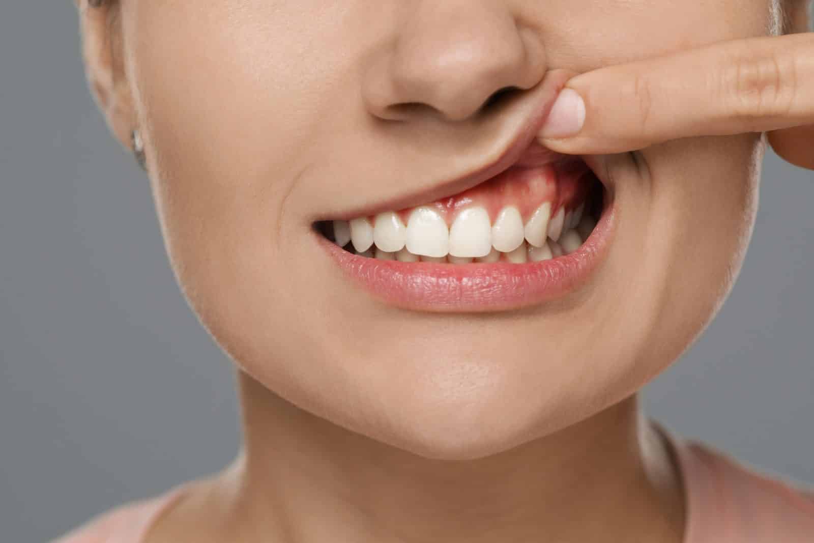 Close-up of healthy teeth and gums illustrating good gum health at Dental Nook Brisbane