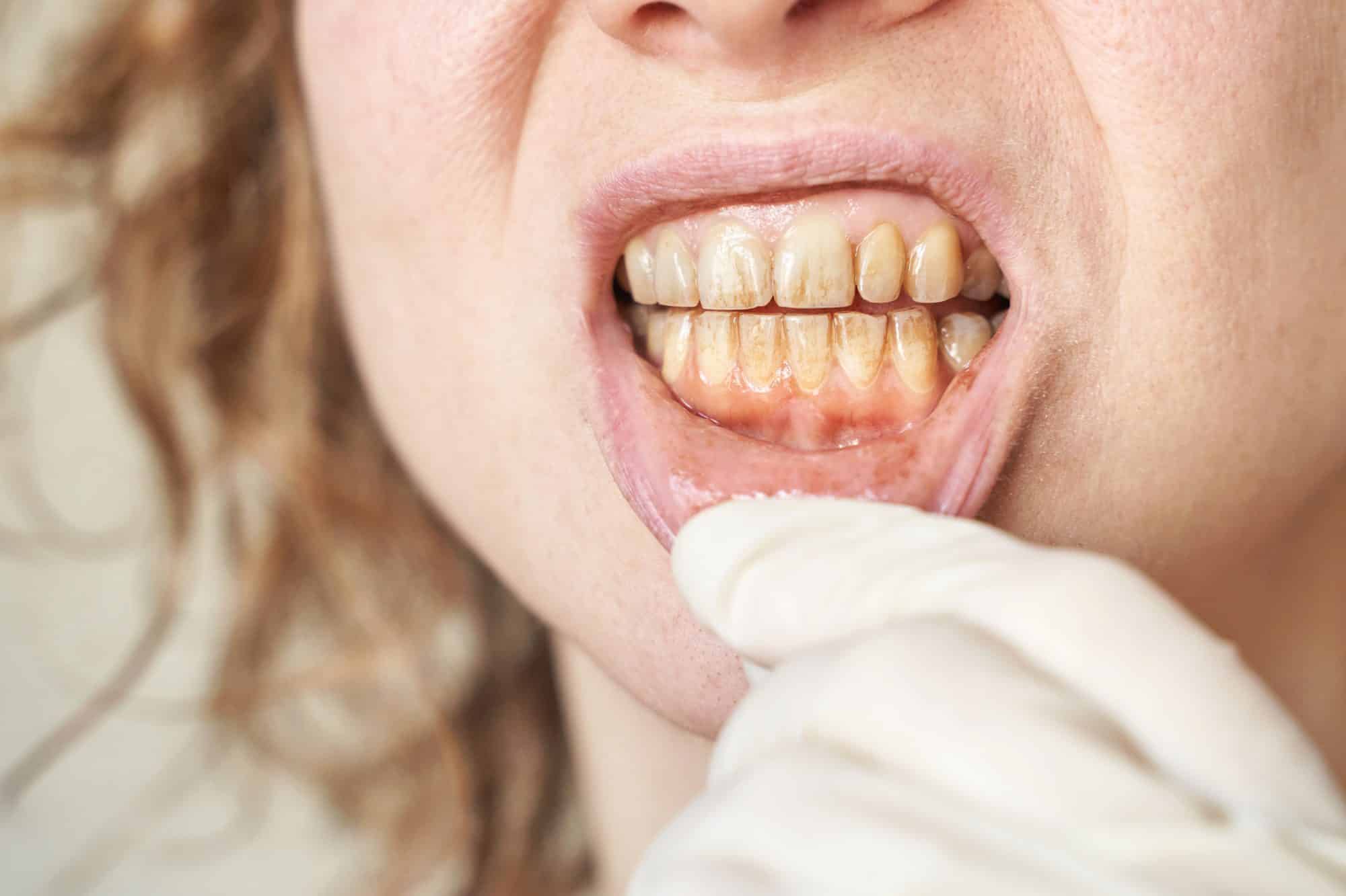 Dentist examining teeth stained and discoloured by smoking